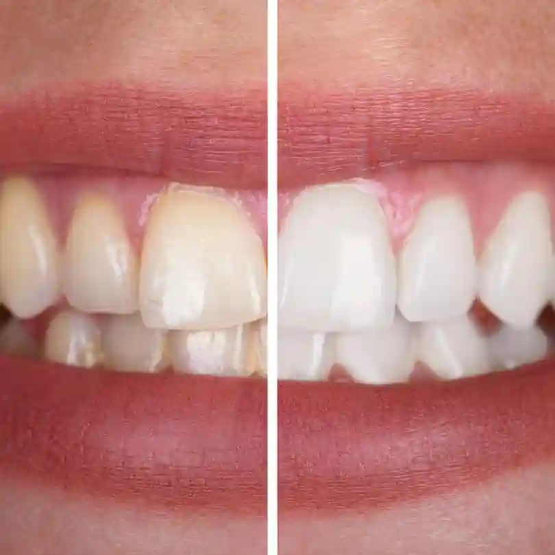 whitening