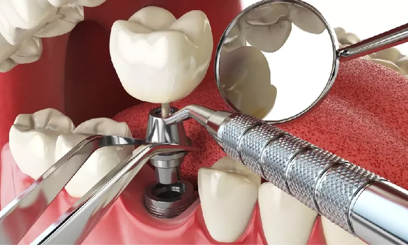 Dental Implants