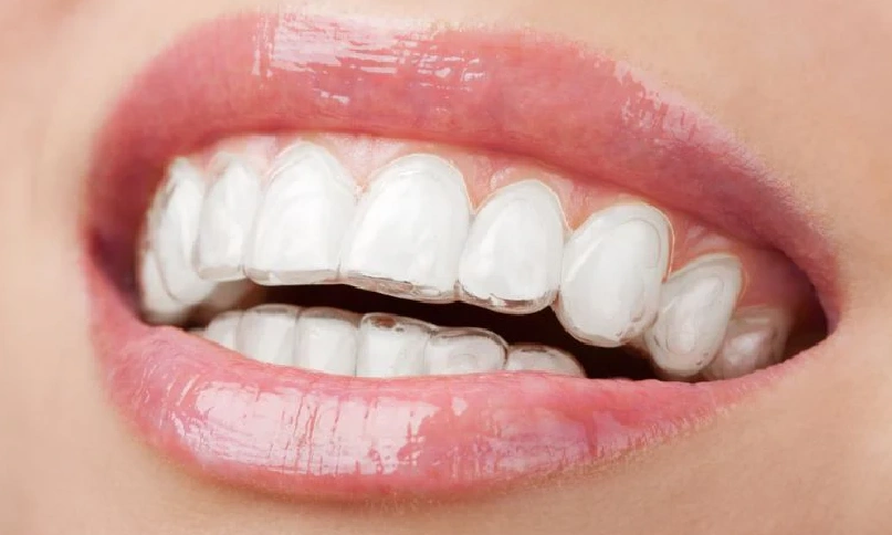 Invisalign copy 4