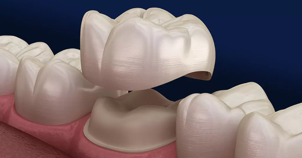 Dental Crowns