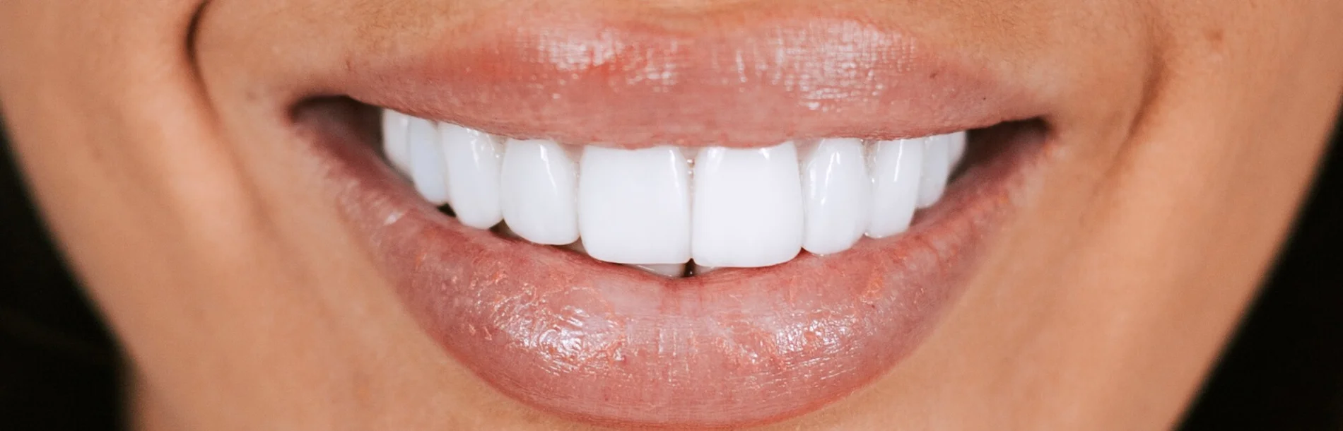 Porcelain Veneers