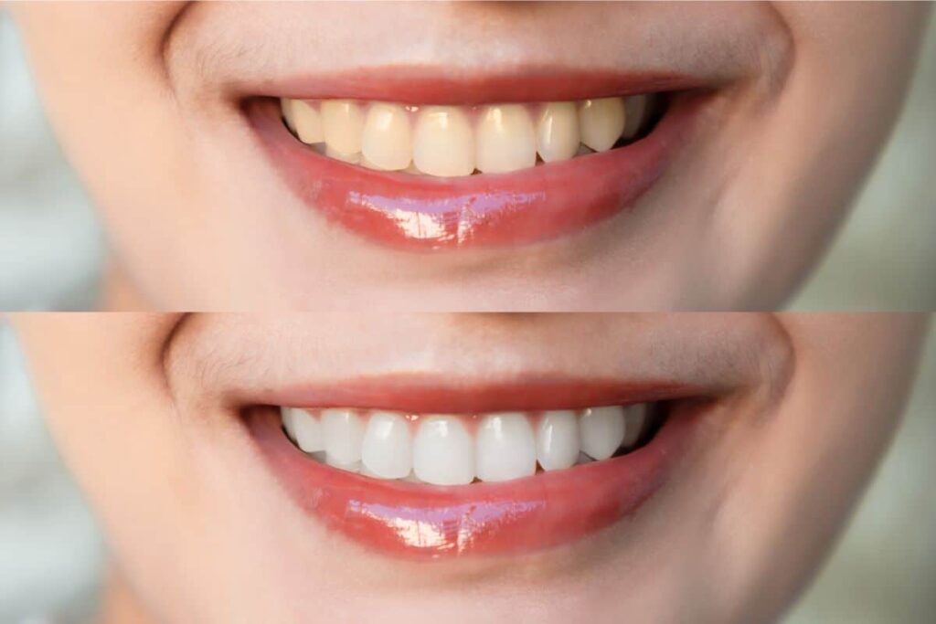 cosmetic dentistry before and after